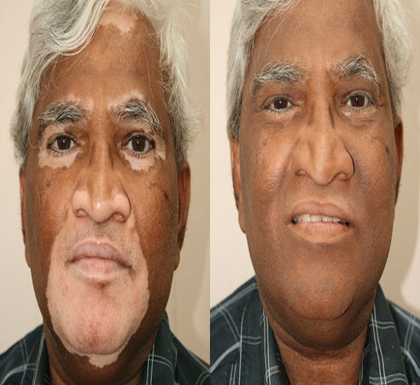 Slimapro Before After 3